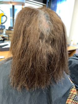 毛染めによる頭皮のかぶれ 赤い湿疹 痛み痒みがありました ブルーヘアー 毛染めによる頭皮のかぶれ 赤い湿疹 痛み痒みがありました ブルーヘアー